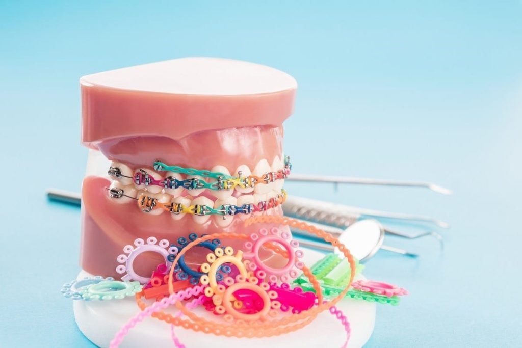 Do Clear Braces Take Longer