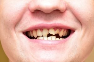 Why Might Someone Require Dental Braces Liverpool