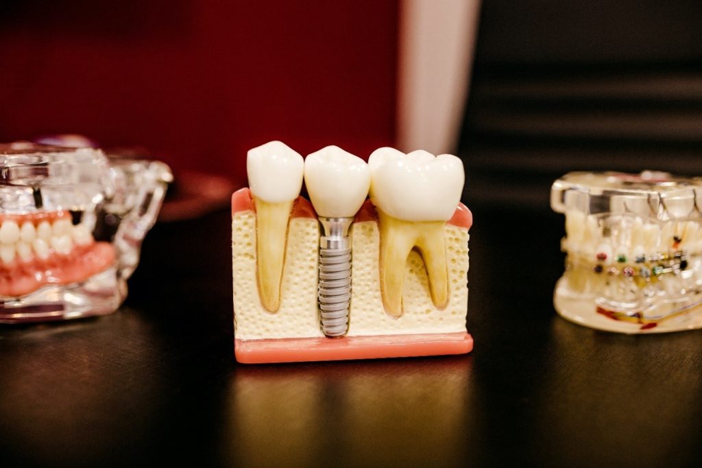Conquering Tooth Loss With Oral Implants