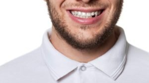 Using Dental Implants To Rectify The Effects Of Tooth Loss